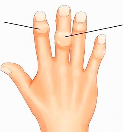 Възли на Heberden и Bouchard на интерфалангеалните стави с артроза