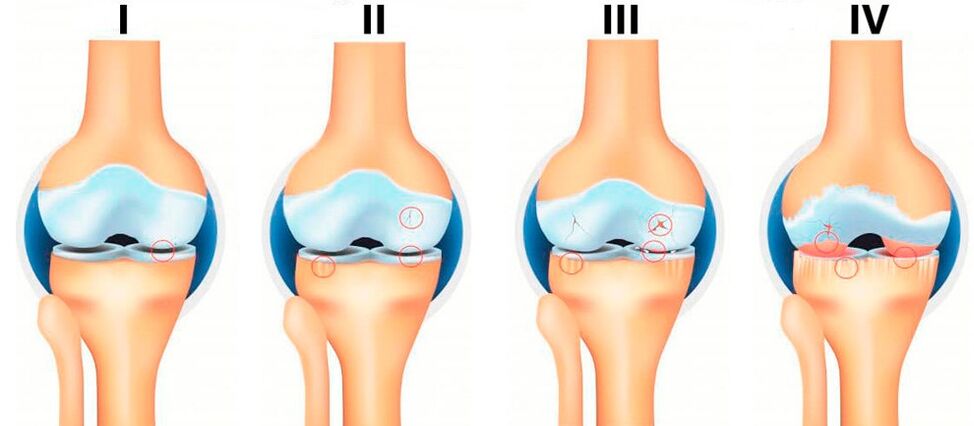 етапи на артроза
