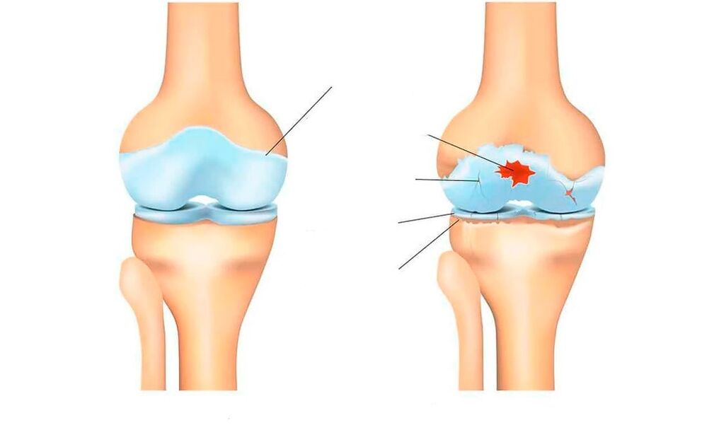здрави стави и с артроза