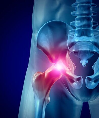снимка на болка в тазобедрената става 1